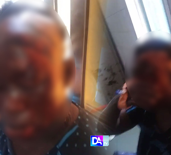 MBACKÉ – Attaque à l’acide : une femme grièvement blessée par la sœur de son époux… La présumée coupable en fuite