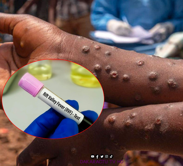 Sénégal: 20 morts depuis fin septembre dans une épidémie de la fièvre de la Vallée du Rift (ministère)
