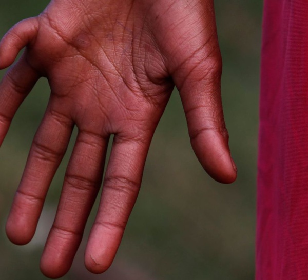 Chine: un garçon né avec 16 doigts et 15 orteils espère une opération