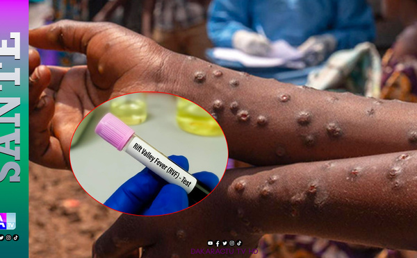 Fièvre de la Vallée du Rift : 25 décès enregistrés depuis le début de l’épidémie